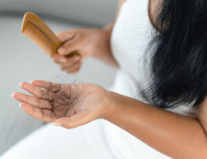 Hair Loss from PCOS